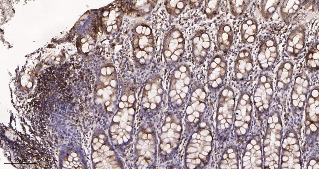 Immunohistochemical analysis of paraffin-embedded human colon tissue. 1, CD8 α Rabbit Monoclonal Antibody was diluted at 1:200(4°C,overnight). 2, EDTA pH 9.0 was used for antibody retrieval(>98°C,20min). 3,Secondary antibody was diluted at 1:200(room temperature,30min).