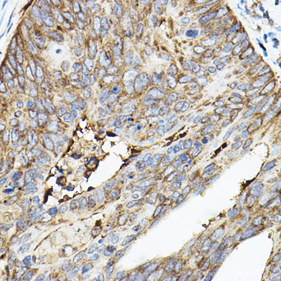 Immunohistochemistry analysis of paraffin-embedded Human colon carcinoma using ROCK2 Rabbit pAb at dilution of 1:50 (40x lens). High pressure antigen retrieval performed with 0.01M Citrate buffer (pH 6.0) prior to IHC staining.